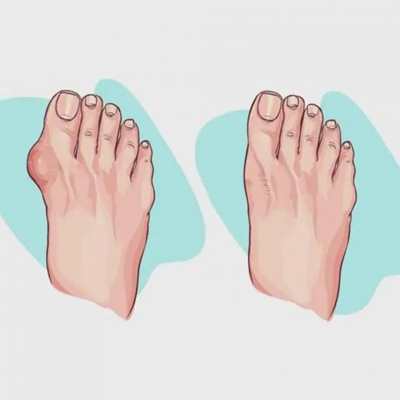 Women Shoes Slippers Orthopedic Bunion Corrector Comfy Platform Ladies Casual Big Toe Correction Sandal Sandalias De Mujer